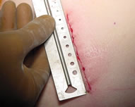 Measuring the incision